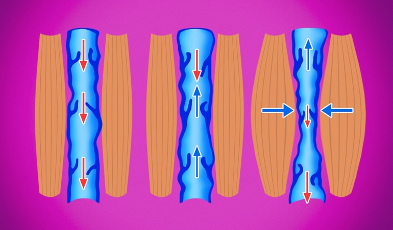 Ilustrace žilní nedostatečnosti, na níž je vidět abnormální komprese žíly a další ztráta elasticity, která brání oběhu krve